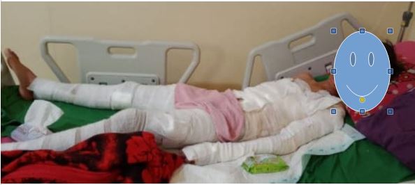 Polisi Selidiki Kasus Bocah SD, Bermain Berujung Luka Bakar